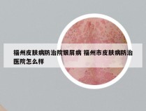 福州皮肤病防治院银屑病 福州市皮肤病防治医院怎么样