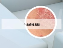 牛皮癣排发期