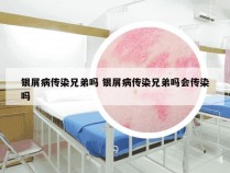 银屑病传染兄弟吗 银屑病传染兄弟吗会传染吗
