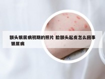 额头银屑病初期的照片 脸额头起皮怎么回事 银屑病