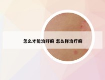 怎么才能治好癣 怎么样治疗癣