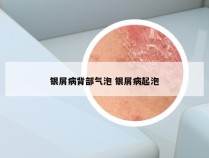 银屑病背部气泡 银屑病起泡