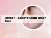 蜈蚣有毒为什么能治严重的银屑病 蜈蚣毒性能治么