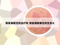 银屑病需住院治疗吗 银屑病需要住院住多久