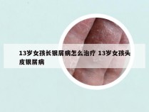 13岁女孩长银屑病怎么治疗 13岁女孩头皮银屑病