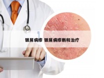 银屑病疹 银屑病疹断和治疗