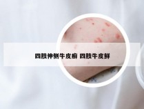 四肢伸侧牛皮癣 四肢牛皮鲜