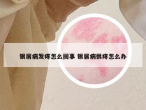 银屑病发疼怎么回事 银屑病很疼怎么办