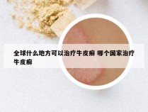 全球什么地方可以治疗牛皮癣 哪个国家治疗牛皮癣