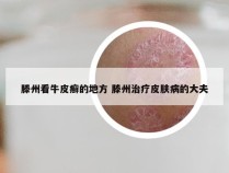 滕州看牛皮癣的地方 滕州治疗皮肤病的大夫