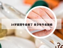 16岁就得牛皮癣了 青少年牛皮肤癣