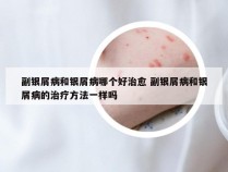 副银屑病和银屑病哪个好治愈 副银屑病和银屑病的治疗方法一样吗