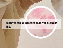 嘴唇严重脱皮是银屑病吗 嘴唇严重脱皮是缺什么