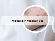 牛皮癣治不了 牛皮癣治不了嘛