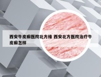 西安牛皮癣医院北方维 西安北方医院治疗牛皮癣怎样
