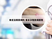 秦皮治银屑病吗 秦皮治银屑病原理