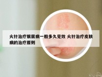 火针治疗银屑病一般多久见效 火针治疗皮肤病的治疗原则