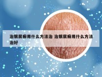 治银屑癣用什么方法治 治银屑癣用什么方法治好