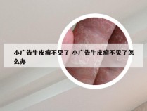小广告牛皮癣不见了 小广告牛皮癣不见了怎么办