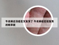 牛皮癣还没痊愈又复发了 牛皮癣痊愈后复发的概率就