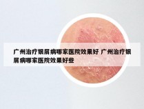 广州治疗银屑病哪家医院效果好 广州治疗银屑病哪家医院效果好些