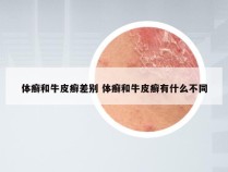 体癣和牛皮癣差别 体癣和牛皮癣有什么不同