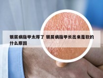 银屑病指甲太厚了 银屑病指甲长出来是软的什么原因
