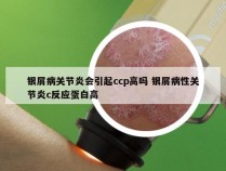 银屑病关节炎会引起ccp高吗 银屑病性关节炎c反应蛋白高