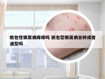 脓包性银屑病痒痒吗 脓包型银屑病会转成普通型吗