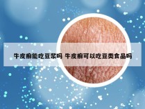 牛皮癣能吃豆浆吗 牛皮癣可以吃豆类食品吗