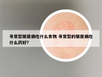 寻常型银屑病吃什么食物 寻常型的银屑病吃什么药好?