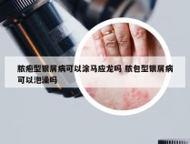 脓疱型银屑病可以涂马应龙吗 脓包型银屑病可以泡澡吗