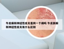 牛皮癣和神经性皮炎是同一个病吗 牛皮肤癣和神经性皮炎有什么区别