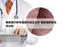 银屑病只照窄谱紫外线怎么样 银屑病照紫光可以吗