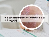 银屑病目前治好还有白点没 银屑病好了之后有白印正常吗