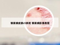 银屑病皮肤ct表现 银屑病影像表现