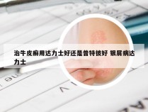 治牛皮癣用达力士好还是普特彼好 银屑病达力士