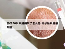 怀孕30周银屑病发了怎么办 怀孕后银屑病加重