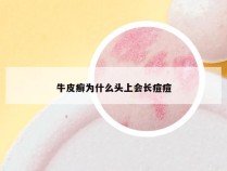 牛皮癣为什么头上会长痘痘