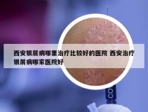 西安银屑病哪里治疗比较好的医院 西安治疗银屑病哪家医院好