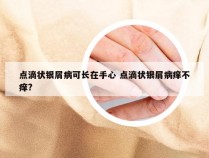 点滴状银屑病可长在手心 点滴状银屑病痒不痒?