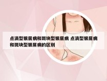 点滴型银屑病和斑块型银屑病 点滴型银屑病和斑块型银屑病的区别