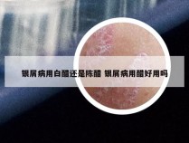 银屑病用白醋还是陈醋 银屑病用醋好用吗