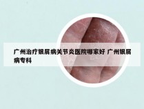广州治疗银屑病关节炎医院哪家好 广州银屑病专科