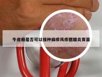 牛皮癣是否可以接种麻疹风疹腮腺炎育苗