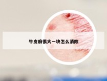 牛皮癣很大一块怎么消除