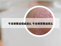牛皮癣要戒烟戒酒么 牛皮癣需要戒烟么