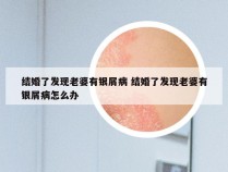 结婚了发现老婆有银屑病 结婚了发现老婆有银屑病怎么办