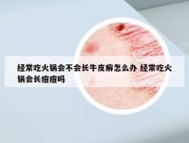 经常吃火锅会不会长牛皮癣怎么办 经常吃火锅会长痘痘吗