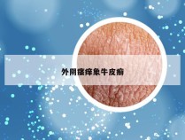 外阴瘙痒象牛皮癣